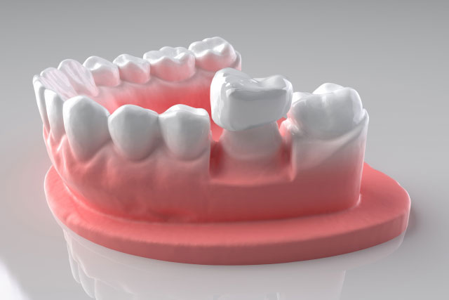 保険適用の白いかぶせもの「CAD/CAM冠」